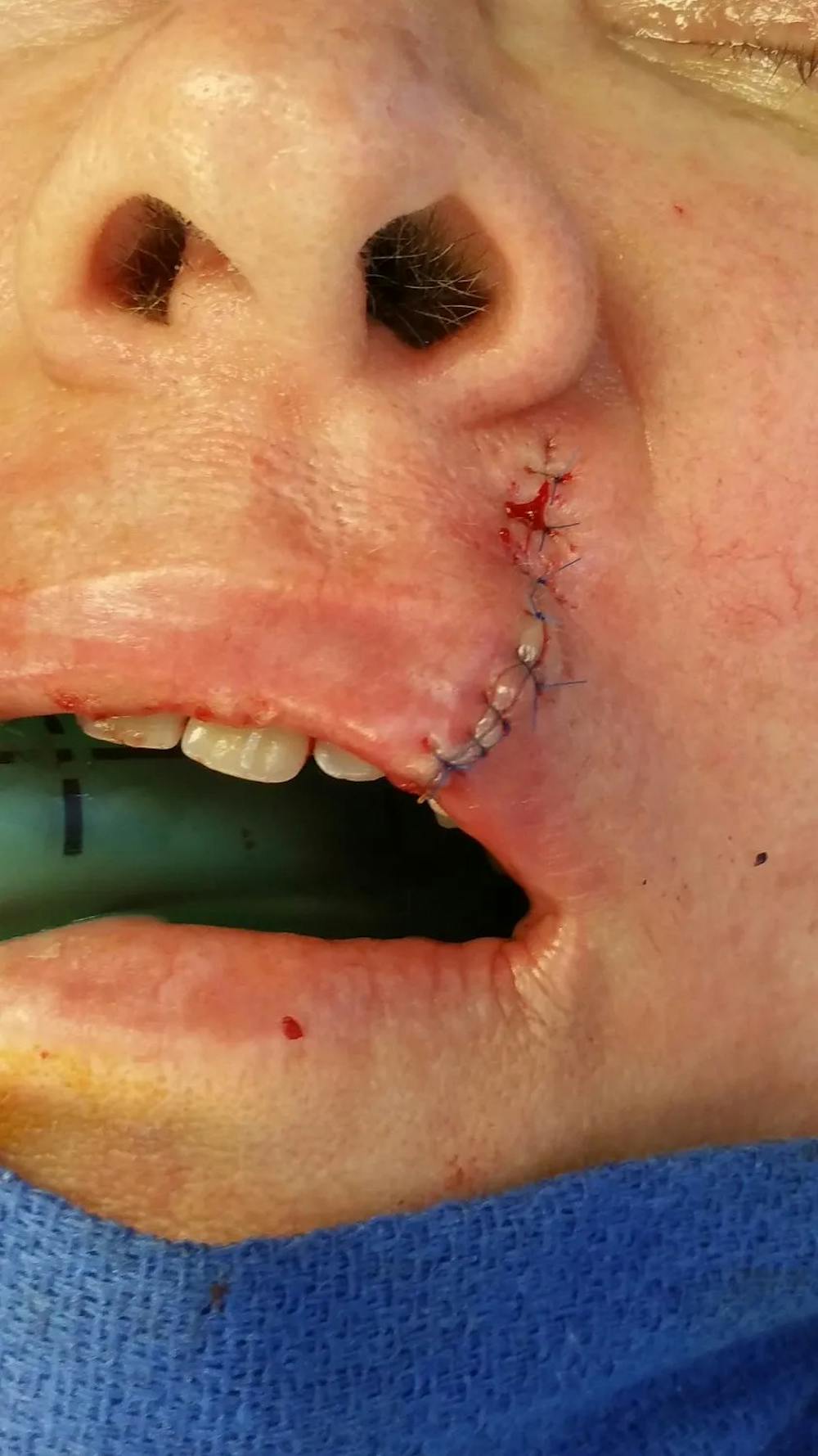 Facial and MOHS Reconstruction Before & After Gallery - Patient 5800847 - Image 3