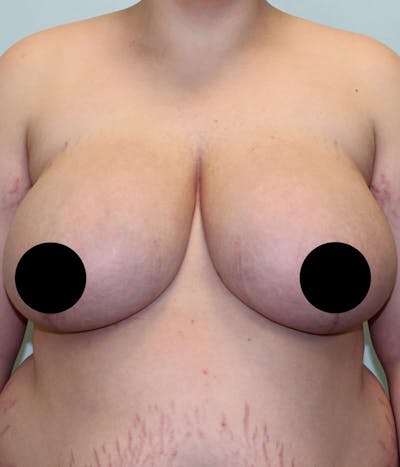 Breast Augmentation Gallery - Patient 121820032 - Image 1