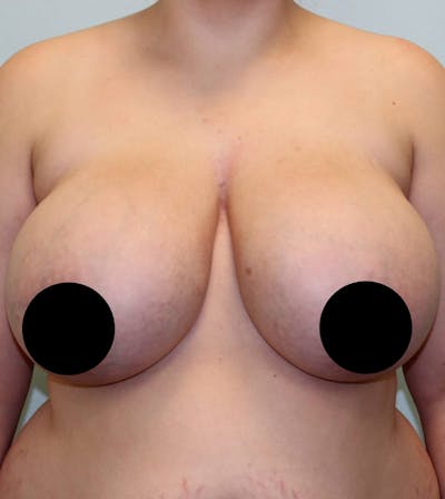 Breast Reduction Before & After Gallery - Patient 5799673 - Image 1