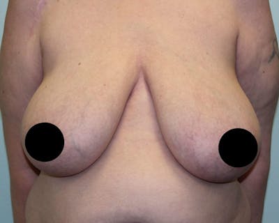 Breast Reduction Before & After Gallery - Patient 5799675 - Image 1