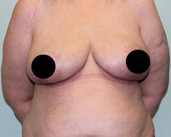 Breast Reduction Before & After Gallery - Patient 5799675 - Image 2