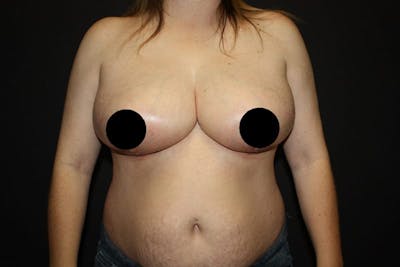 Breast Reduction Before & After Gallery - Patient 5799677 - Image 2