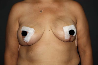 Breast Reduction Before & After Gallery - Patient 5799682 - Image 2