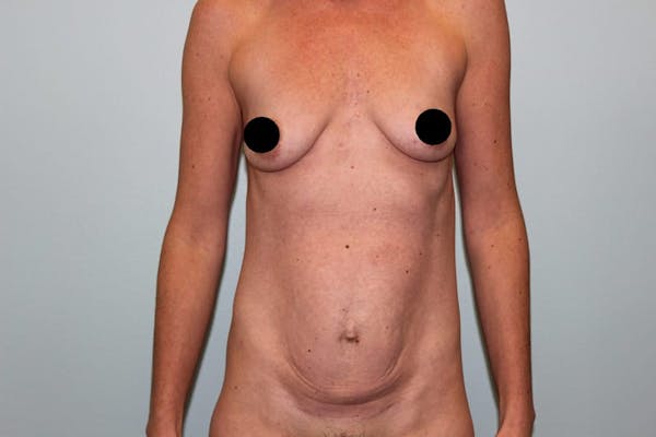 Breast Augmentation Before & After Gallery - Patient 121820033 - Image 1