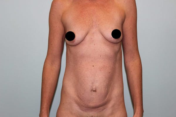 Breast Augmentation Before & After Gallery - Patient 121820033 - Image 1