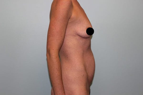 Breast Augmentation Before & After Gallery - Patient 121820033 - Image 5
