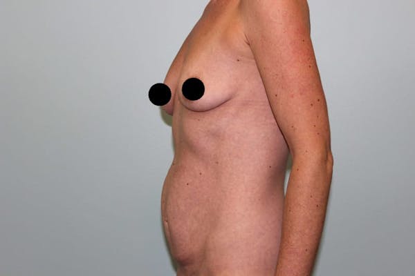 Breast Augmentation Before & After Gallery - Patient 121820033 - Image 7