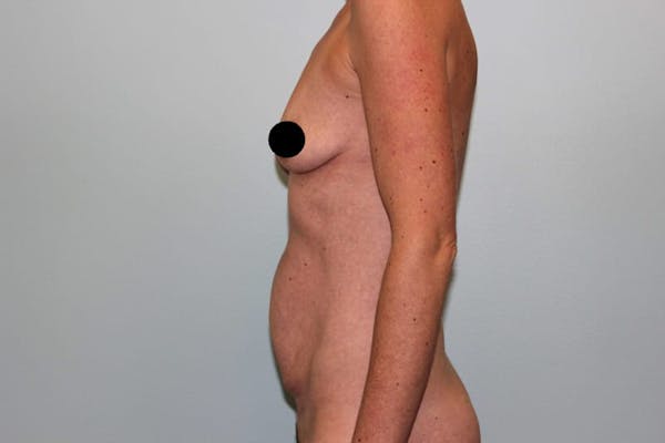 Breast Augmentation Before & After Gallery - Patient 121820033 - Image 9