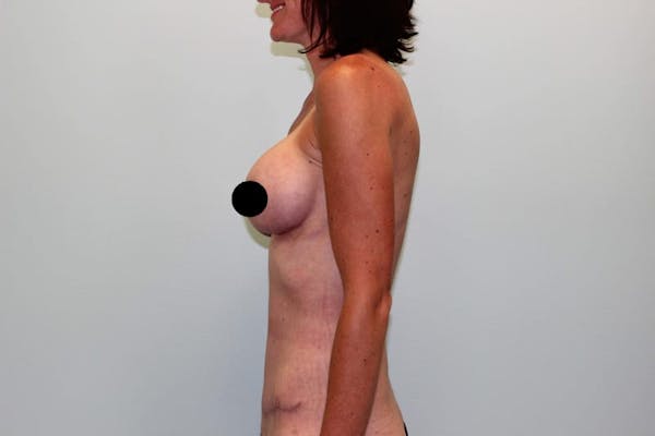 Breast Augmentation Before & After Gallery - Patient 121820033 - Image 10