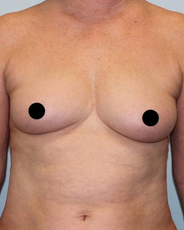 Breast Augmentation Before & After Gallery - Patient 121820034 - Image 1