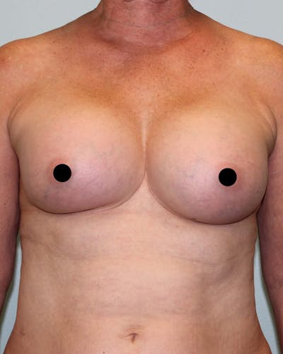Breast Augmentation Before & After Gallery - Patient 121820034 - Image 2