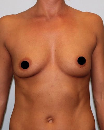 Breast Augmentation Before & After Gallery - Patient 121820035 - Image 1