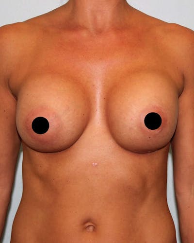 Breast Augmentation Before & After Gallery - Patient 121820035 - Image 2