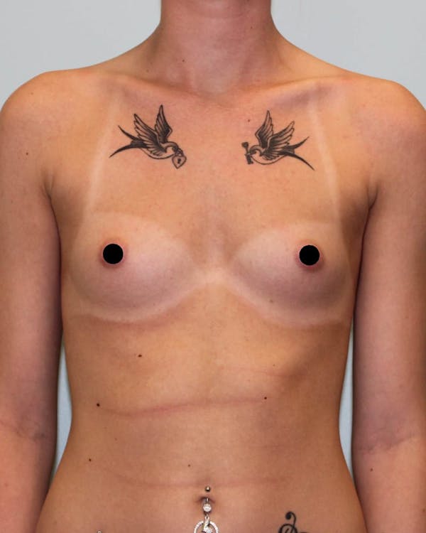 Breast Augmentation Before & After Gallery - Patient 121820036 - Image 1