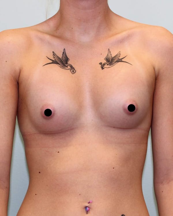 Breast Augmentation Before & After Gallery - Patient 121820036 - Image 2