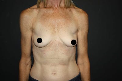Breast Augmentation Before & After Gallery - Patient 121820037 - Image 1