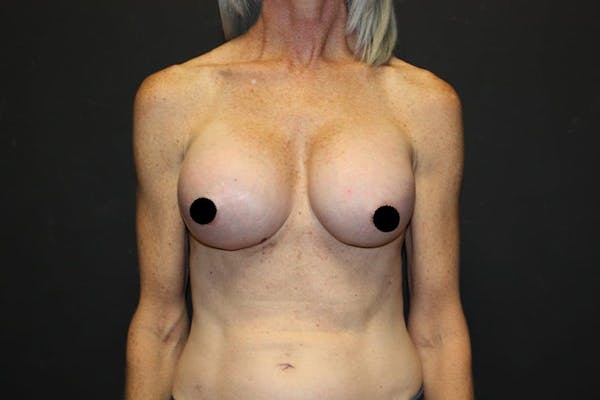 Breast Augmentation Before & After Gallery - Patient 121820037 - Image 2