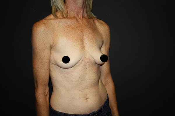 Breast Augmentation Before & After Gallery - Patient 121820037 - Image 3