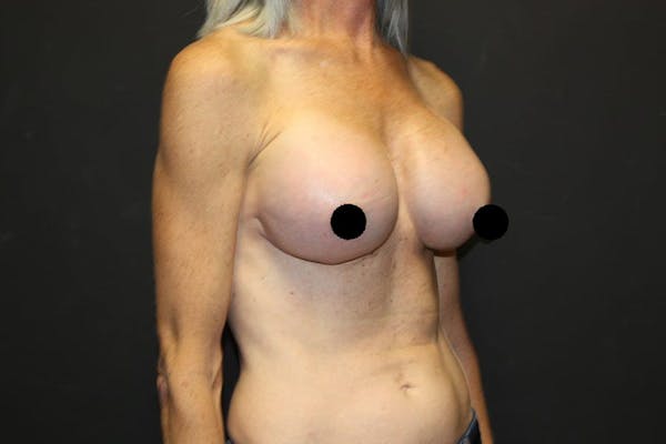 Breast Augmentation Before & After Gallery - Patient 121820037 - Image 4
