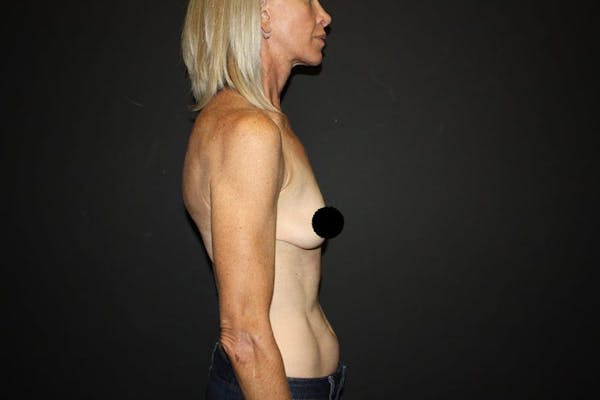 Breast Augmentation Before & After Gallery - Patient 121820037 - Image 5