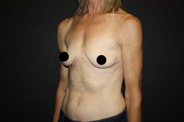 Breast Augmentation Before & After Gallery - Patient 121820037 - Image 7