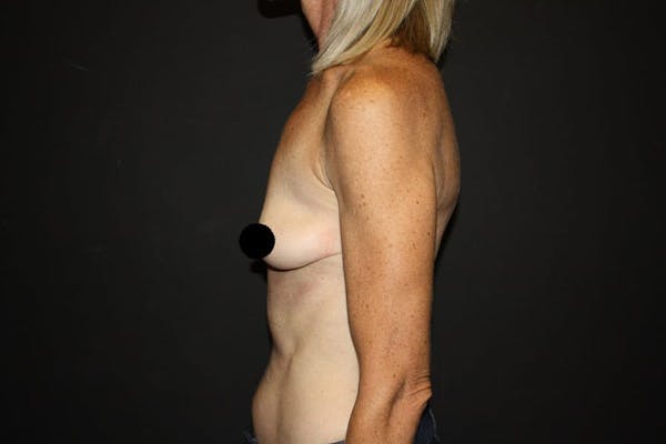 Breast Augmentation Before & After Gallery - Patient 121820037 - Image 9