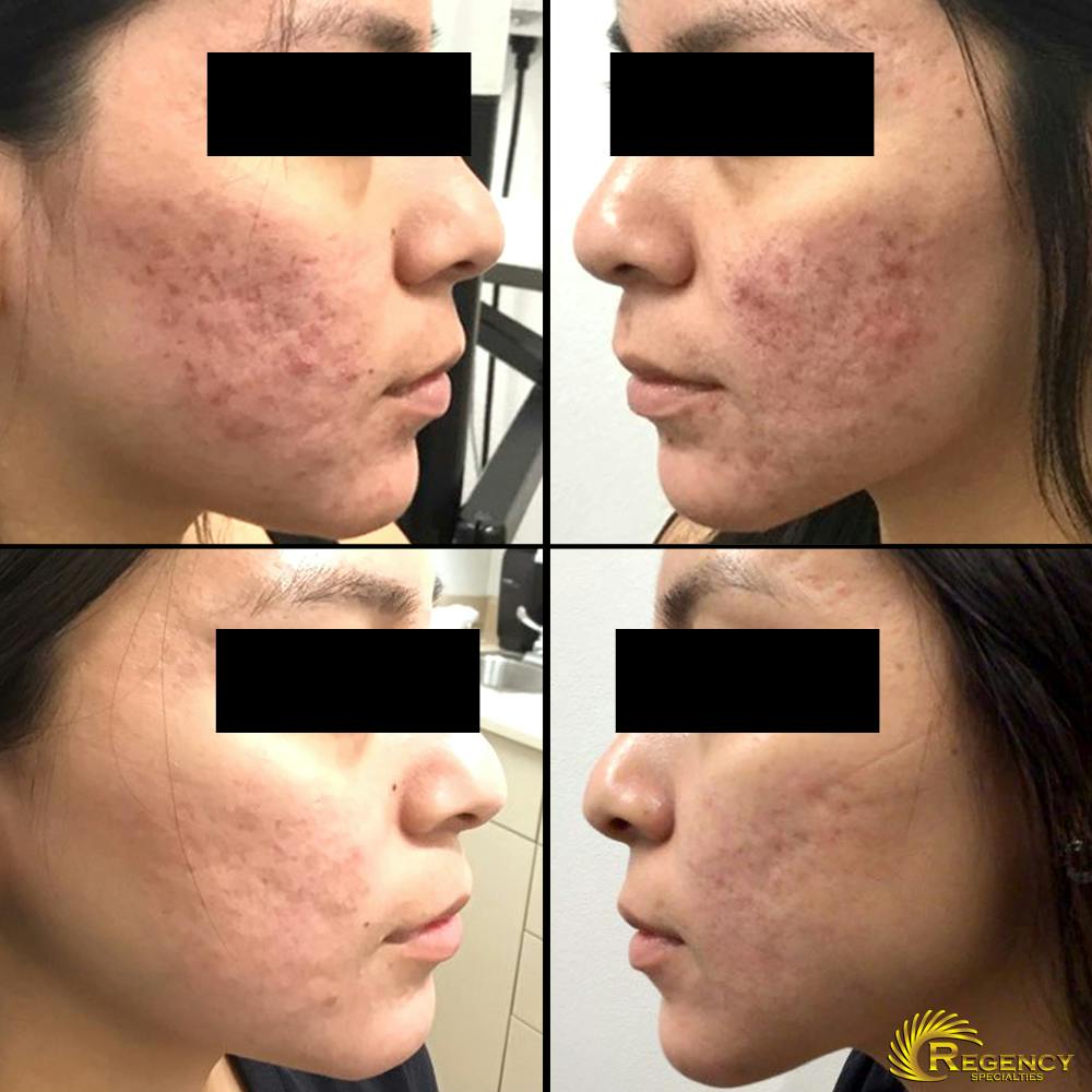 Acne Treatment Before & After Gallery - Patient 6610731 - Image 1