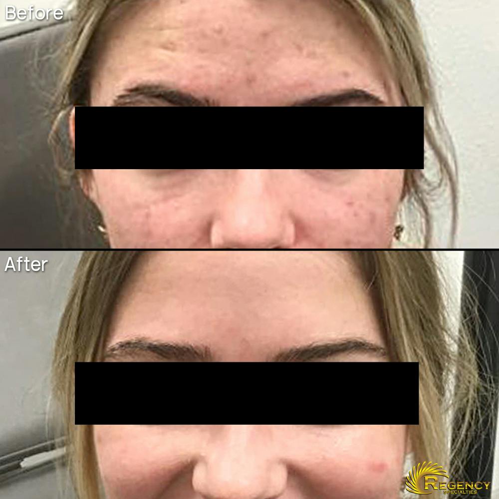 Acne Treatment Before & After Gallery - Patient 6610732 - Image 1