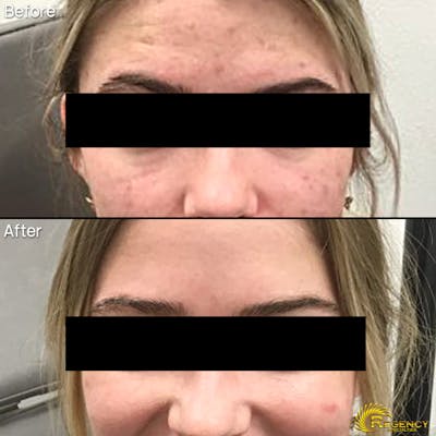 Acne Treatment Before & After Gallery - Patient 6610732 - Image 1