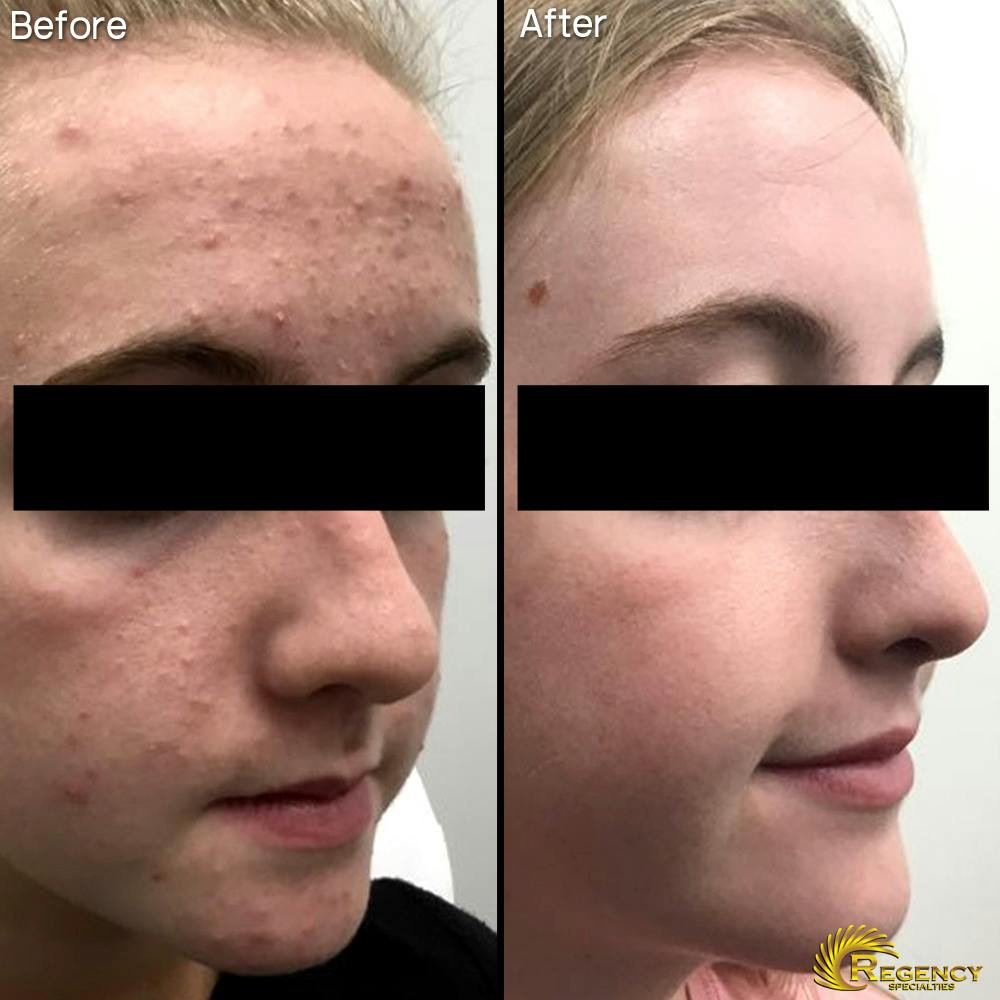 Acne Treatment Before & After Gallery - Patient 6610733 - Image 1