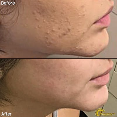 Acne Treatment Before & After Gallery - Patient 6610734 - Image 1