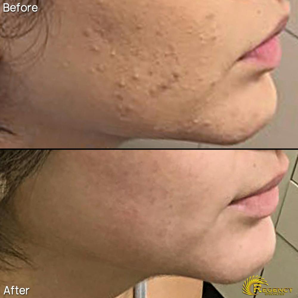 Acne Treatment Before & After Gallery - Patient 6610734 - Image 1