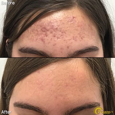 Acne Treatment Before & After Gallery - Patient 6610735 - Image 1