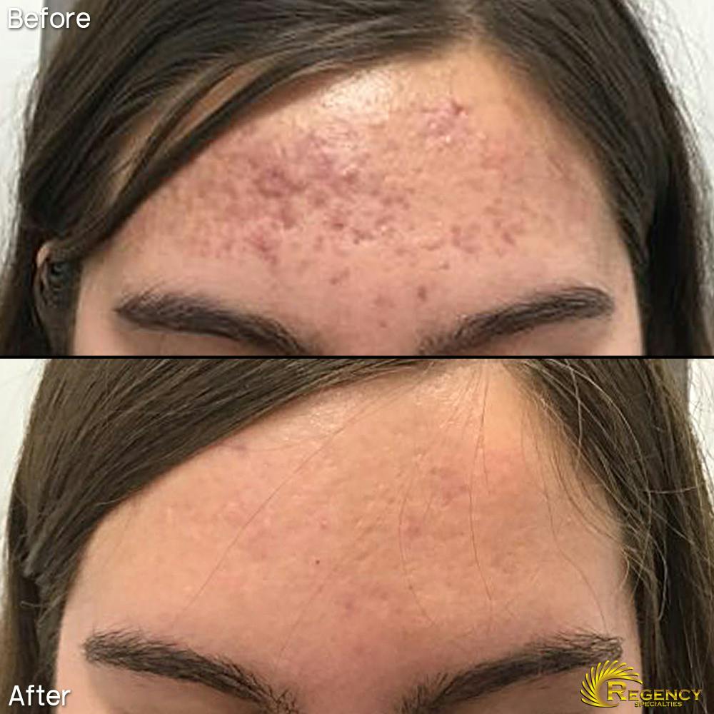Acne Treatment Before & After Gallery - Patient 6610735 - Image 1