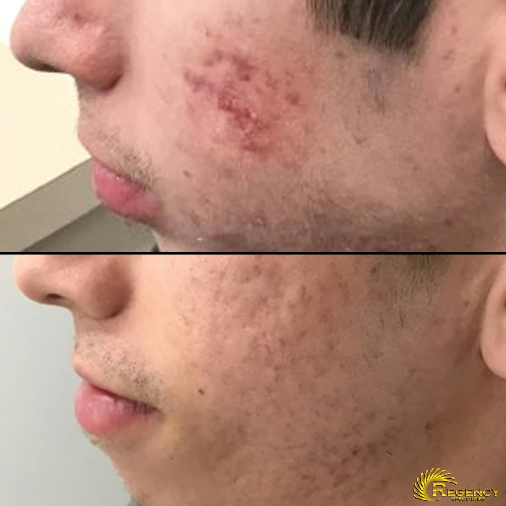 Acne Treatment Before & After Gallery - Patient 6610736 - Image 1