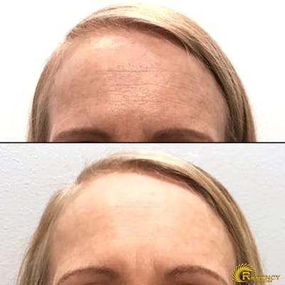 Botox Before & After Gallery - Patient 6610768 - Image 1