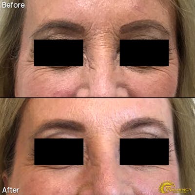 Botox Before & After Gallery - Patient 6610769 - Image 1