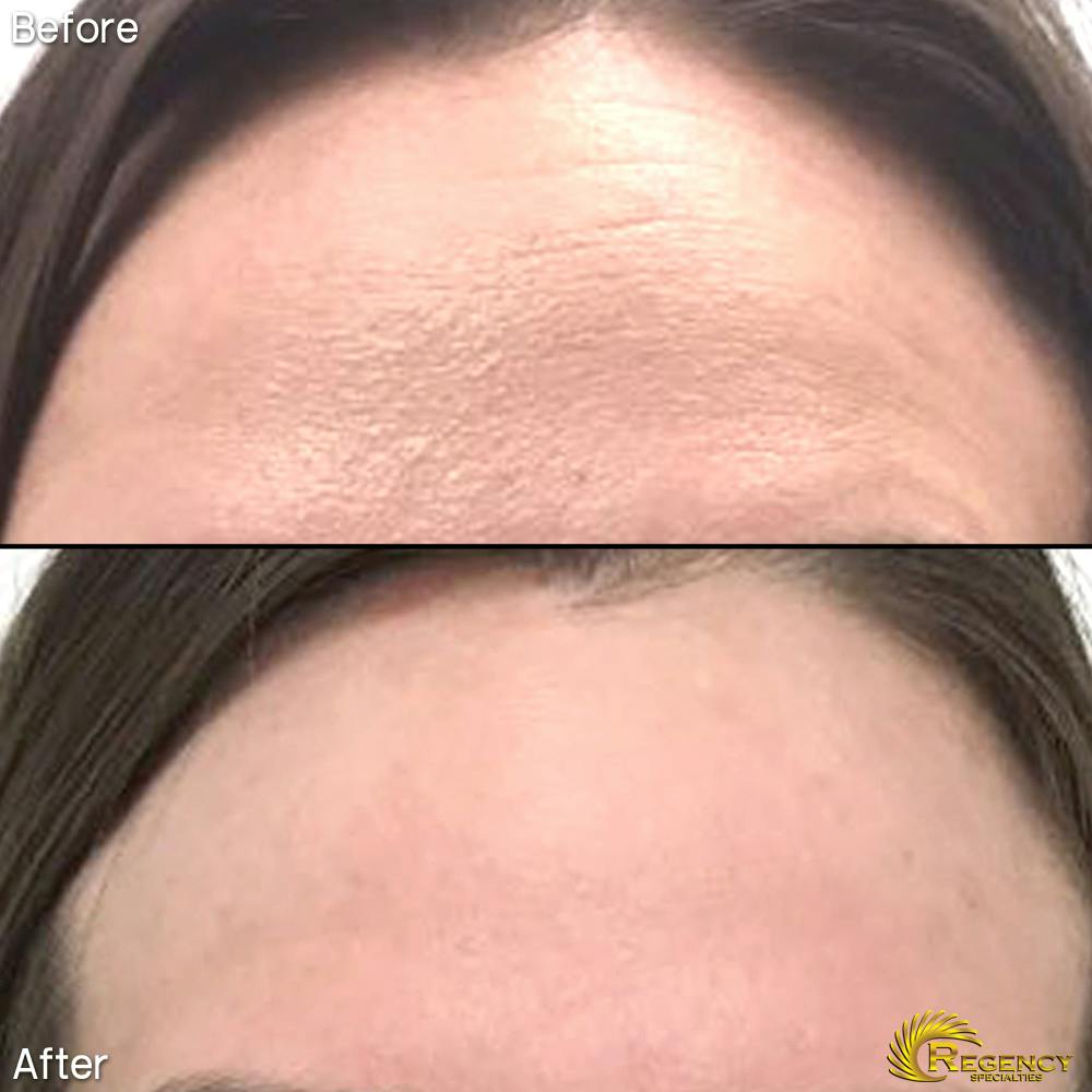 Botox Before & After Gallery - Patient 6610770 - Image 1
