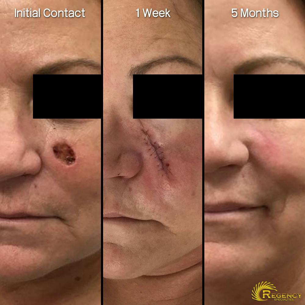 Facial and MOHS Reconstruction Before & After Gallery - Patient 6610915 - Image 1