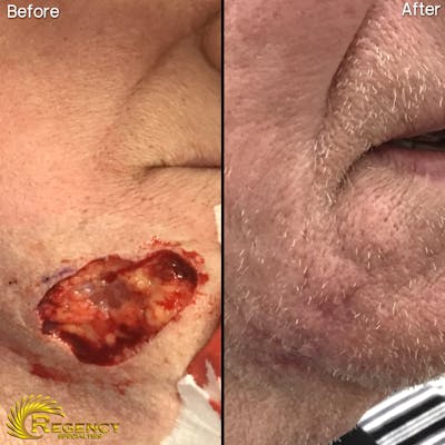 Facial and MOHS Reconstruction Before & After Gallery - Patient 6610916 - Image 1