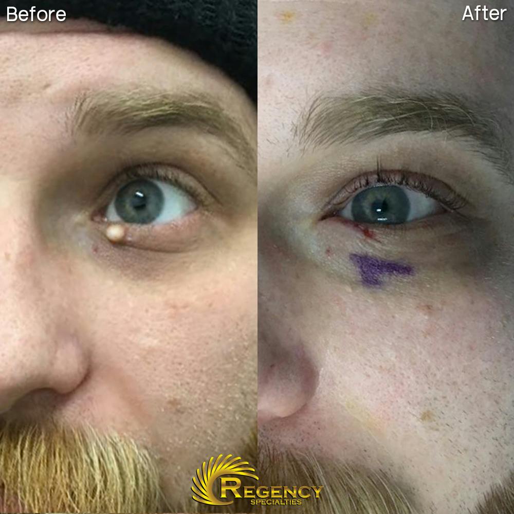 Facial and MOHS Reconstruction Before & After Gallery - Patient 6610917 - Image 1