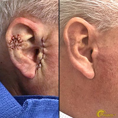 Facial and MOHS Reconstruction Before & After Gallery - Patient 6610918 - Image 1