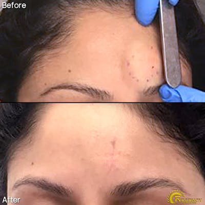 Facial and MOHS Reconstruction Before & After Gallery - Patient 6610919 - Image 1