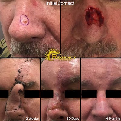 Facial and MOHS Reconstruction Before & After Gallery - Patient 6610920 - Image 1