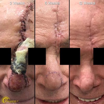 Facial and MOHS Reconstruction Before & After Gallery - Patient 6610921 - Image 1