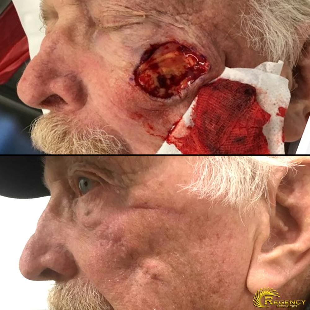 Facial and MOHS Reconstruction Before & After Gallery - Patient 6610922 - Image 1