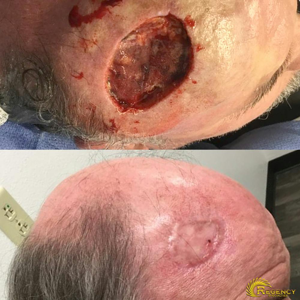 Facial and MOHS Reconstruction Before & After Gallery - Patient 6610923 - Image 1
