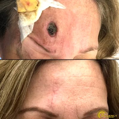Facial and MOHS Reconstruction Before & After Gallery - Patient 6610925 - Image 1