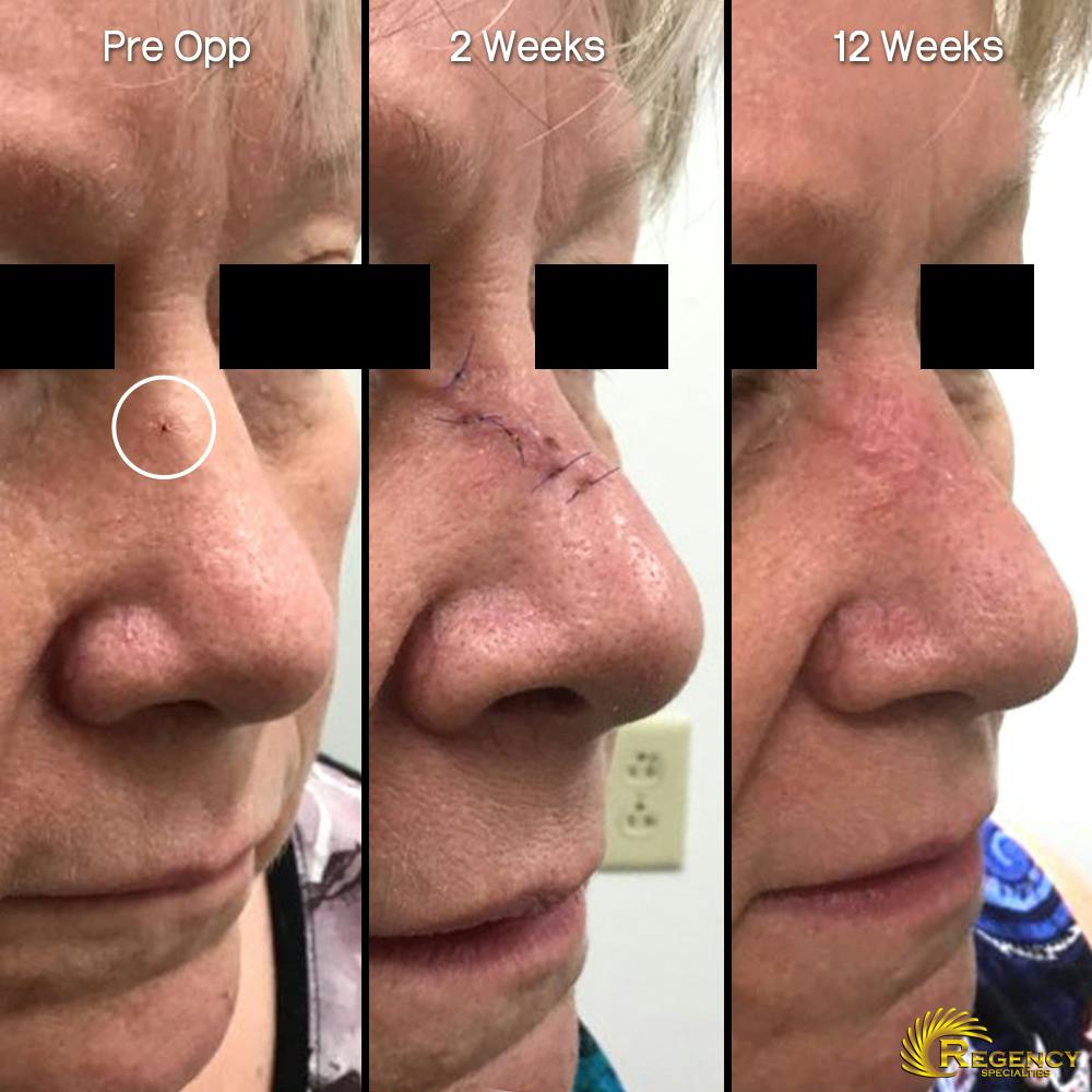 Facial and MOHS Reconstruction Before & After Gallery - Patient 6610926 - Image 1