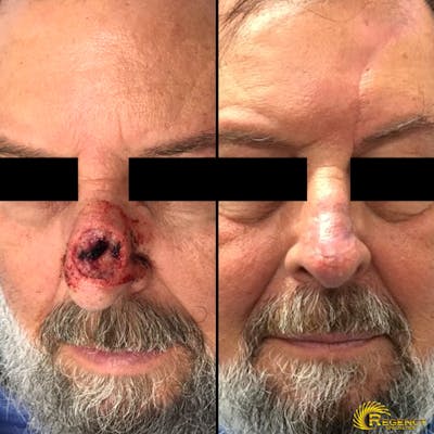 Facial and MOHS Reconstruction Before & After Gallery - Patient 6610927 - Image 1